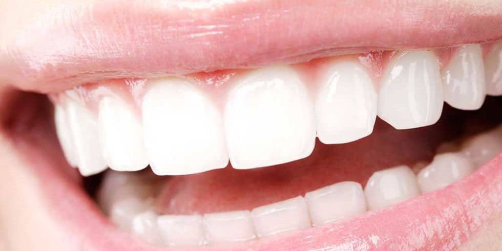 clareamento dental