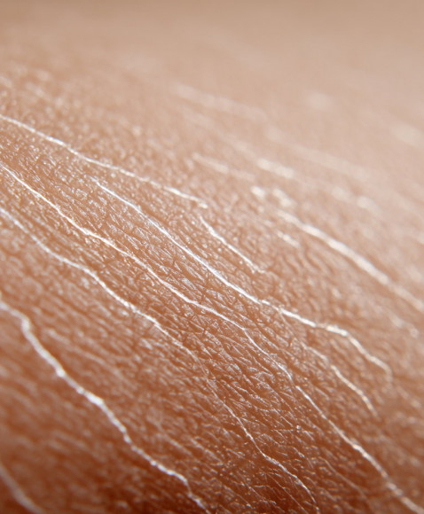 6 Effective tips to prevent stretch marks and improve skin elasticity