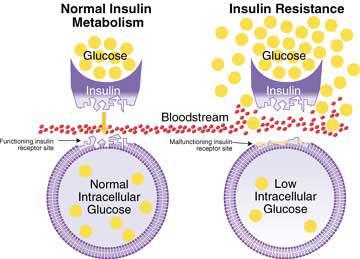Excess Sugar Contributes to Insulin Resistance