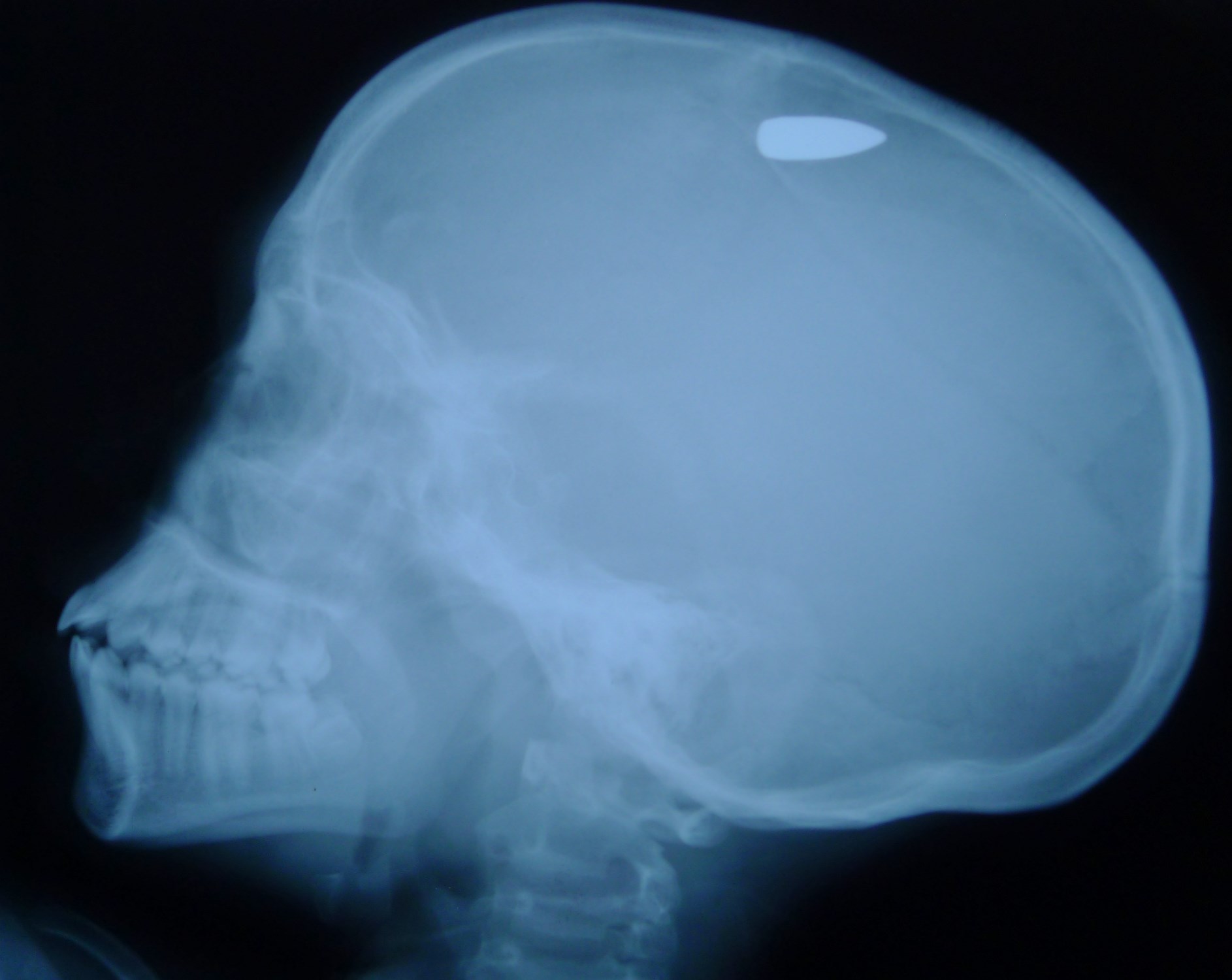 Intentional firearm injuries on the rise in Alaska