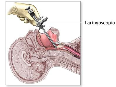 laringoscopia