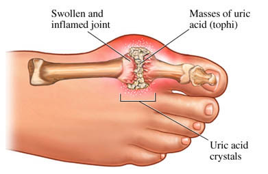 Gout or Joints Pain Due to High Blood Uric Acid Levels