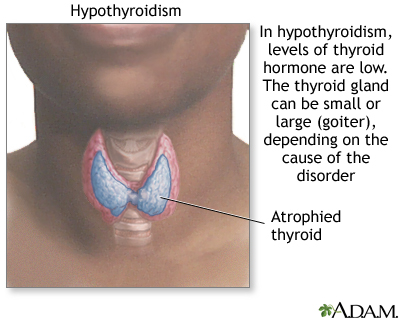 Ayurvedic Treatment for Hypothyroidism