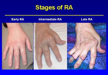 Rheumatoid Arthritis