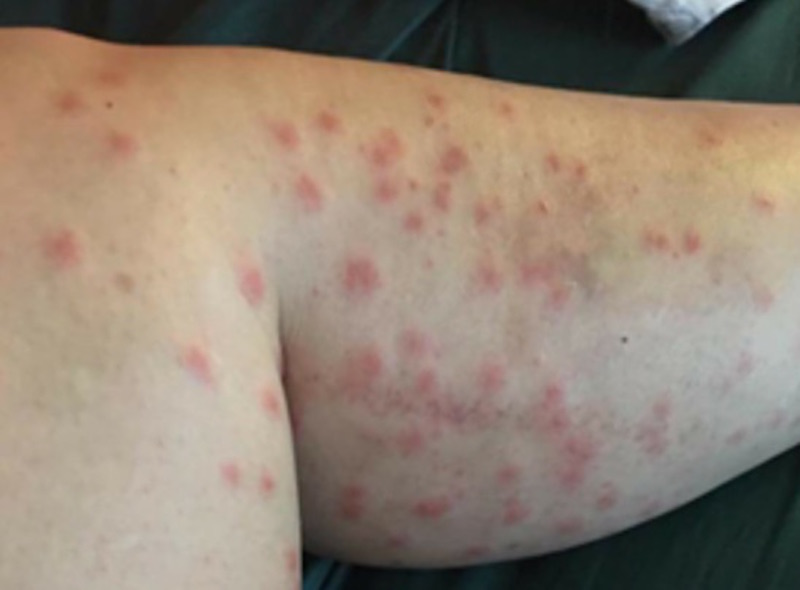 Don't let swimmer's itch happen to you East Idaho News