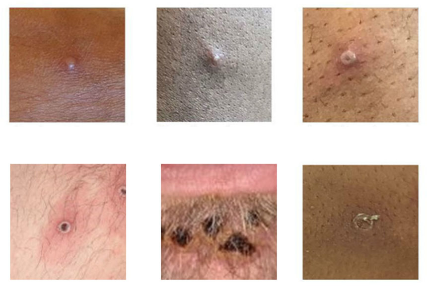 MonkeyPox1
