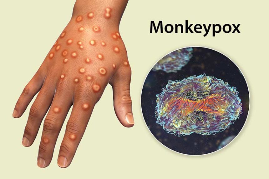 monkeypox