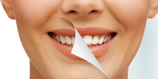 Teeth Whitening Special