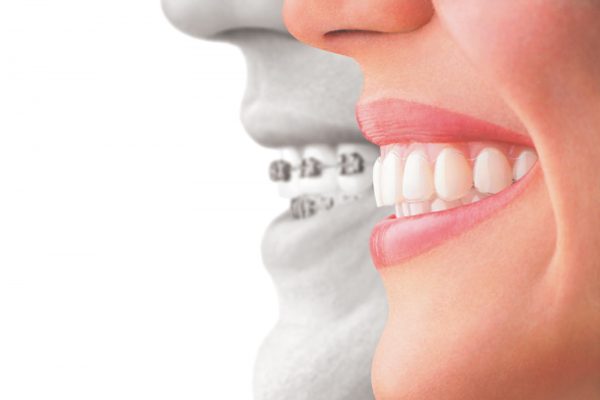 Save $500 on Invisalign or Braces