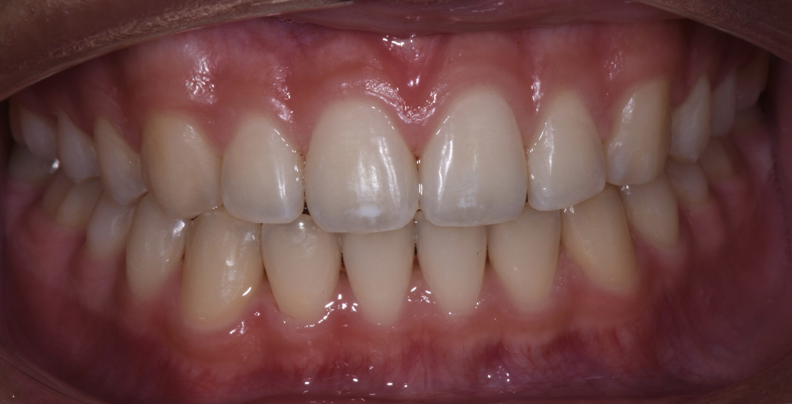 Dental Braces in San Diego, CA Convoy Dental Arts