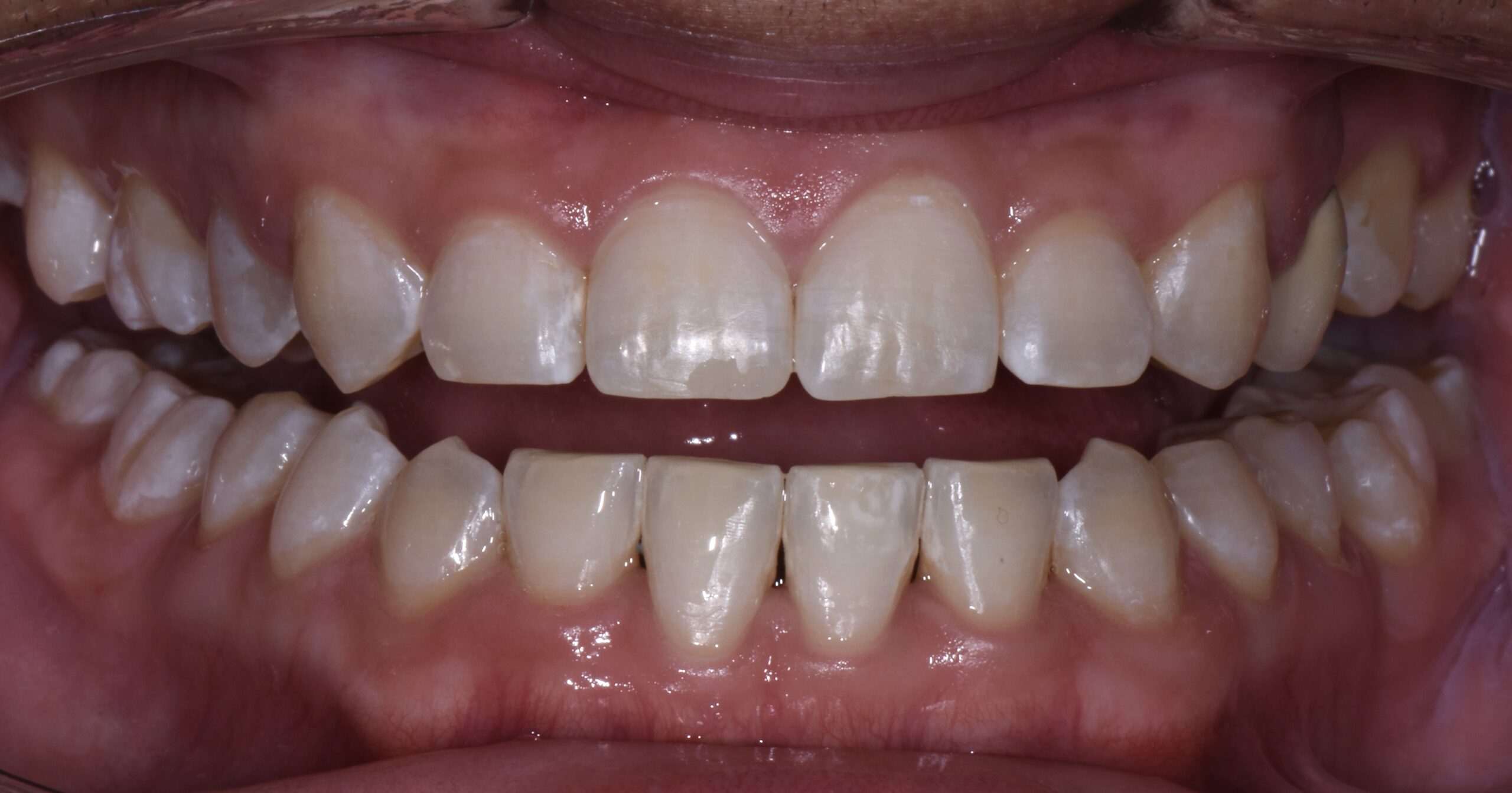 Teeth Whitening & Orthodontic Braces Convoy Dental Arts