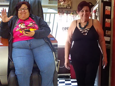 Two images showing a woman before and after weight loss.