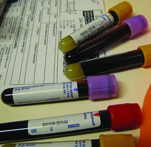 A photograph is shown of 6 vials of blood resting on and near a black and white document. Two of the vials have purple caps, three have tan caps, and one has a red cap. Each has a label and the vials with tan caps have a small amount of an off-white material present in a layer at the base of the vial.