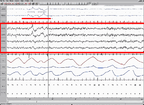 A polysonograph shows 14 rows of waves with some rows appearing visually similar. Rows 1–2, rows 4–7, and rows 9–11 show similar patterns. Rows 4–7 are outlined in read to emphasize the similarity in wave patterns.