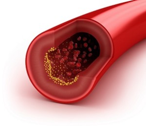 cholesterol artery