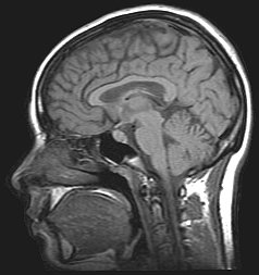 MRI of the brain