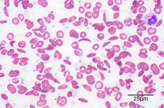 The micrograph shows a smear of red blood cells, some are disc-shaped and compressed in the center, whereas some are crescent-shaped. Each red blood cell is about five microns across.