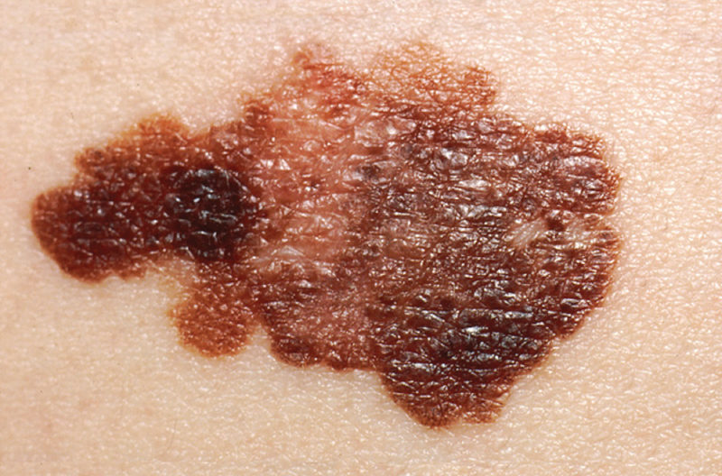 This photo shows a patch of fair skin containing a large melanoma. The melanoma is black and splotchy in appearance.