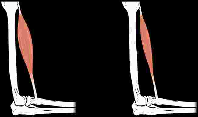 This image shows muscle atrophy. The left panel shows normal muscle and the right panel shows atrophied muscle.