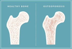 A comparison between a healthy bone and osteoporosis. The healthy bone shows lots of white lines on it, while the osteoporosis bone shows less.