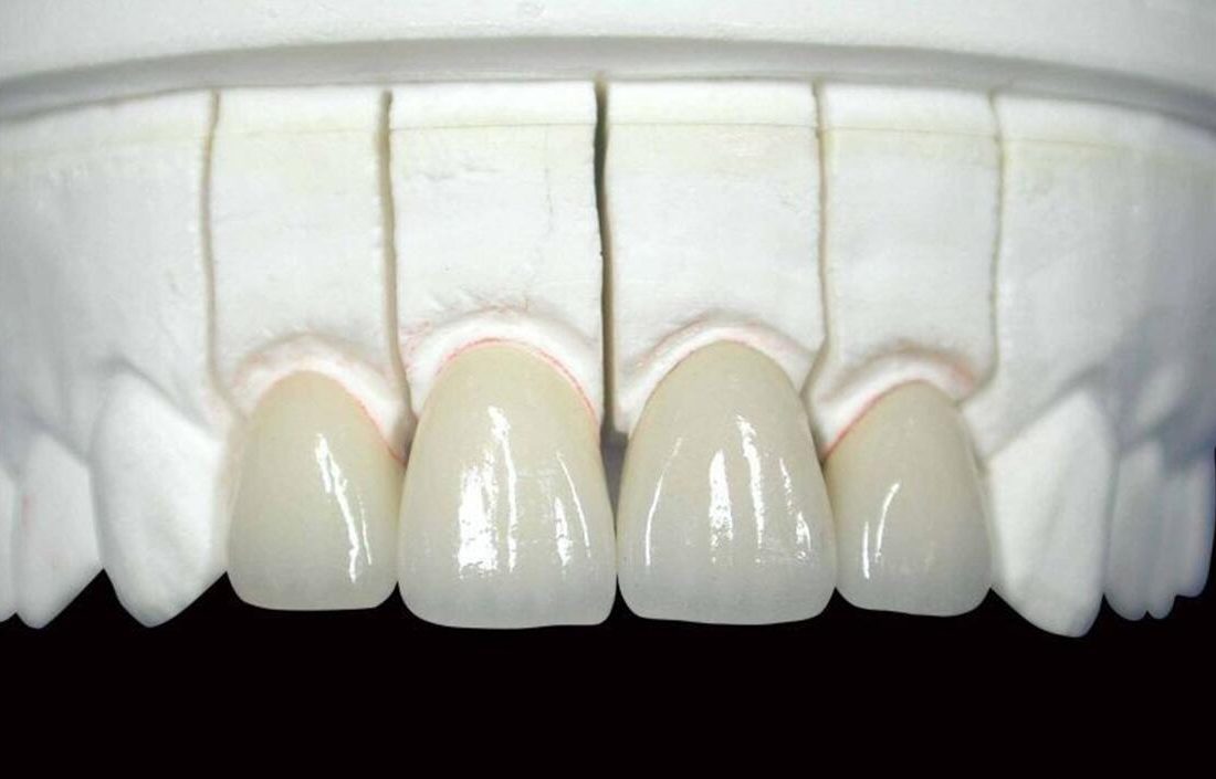 How is the Porcelain Tooth Installed? Dental In Box