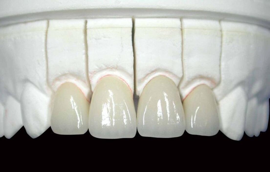 How is the Porcelain Tooth Installed? Dental In Box