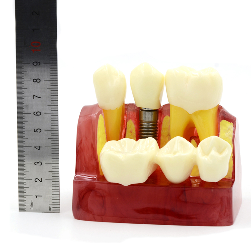Six Reasons for Crown Falling Dental In Box