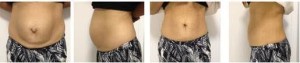 Experts on Diatasis Recti: Hernia and Surgery Care by Julie Tupler - fit2b.com
