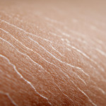 6 Effective tips to prevent stretch marks and improve skin elasticity