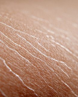 6 Effective tips to prevent stretch marks and improve skin elasticity