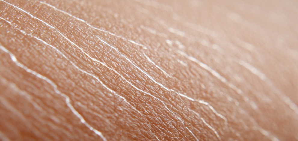 6 Effective tips to prevent stretch marks and improve skin elasticity