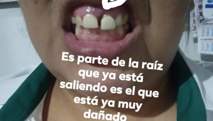 Two Front Teeth