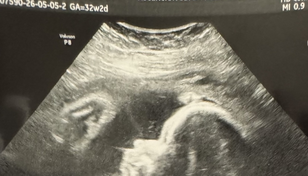 Ultrasound scan showing a developing fetus in the womb at 32 weeks gestational age.
