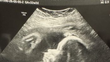Ultrasound scan showing a developing fetus in the womb at 32 weeks gestational age.