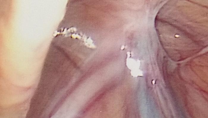 Endoscopic view of internal tissue with visible blood vessels and small white lesions.