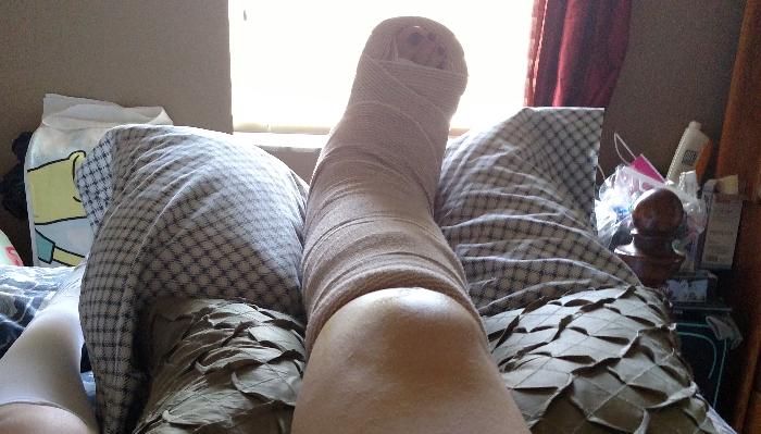 A leg wrapped in a thick beige medical cast resting elevated on patterned pillows in bed.