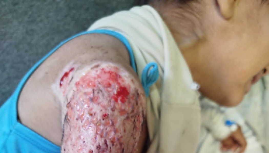 A child lying down with a severe, raw, red skin wound covering their upper arm and shoulder.