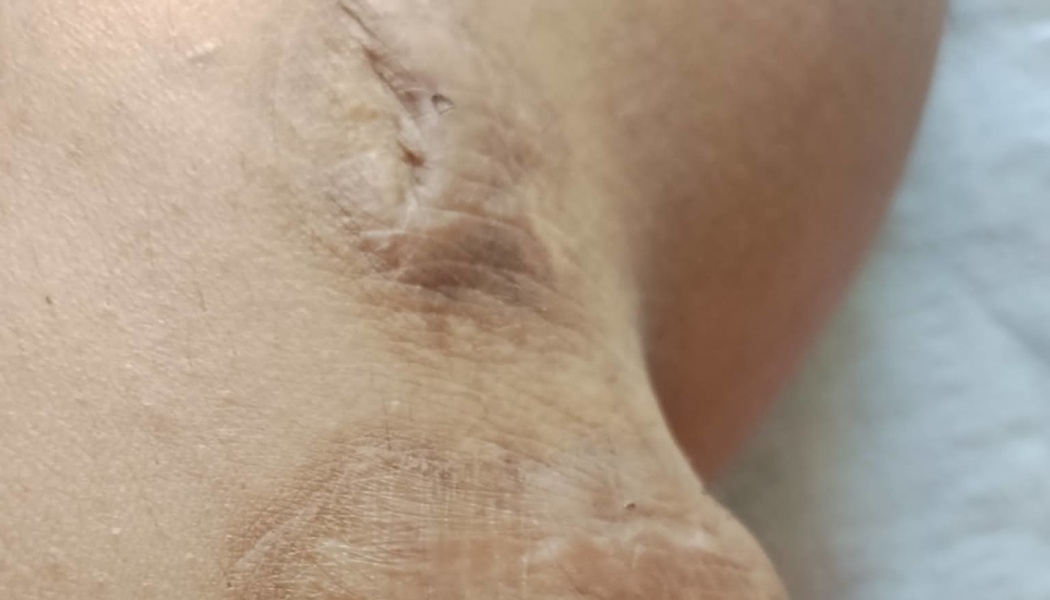 Close-up of puckered scar tissue and discolored skin on a person's body.