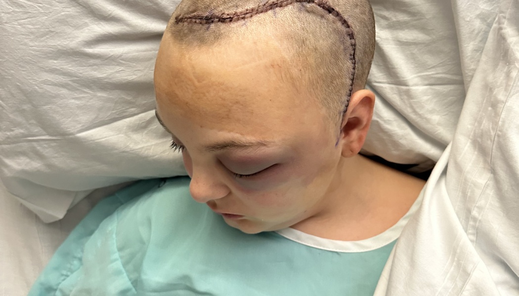 A patient lying in a hospital bed with surgical stitches across their shaved scalp and a bruised eye.