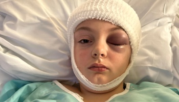 Child lying in a hospital bed with a white head bandage and a severely swollen, bruised eye.