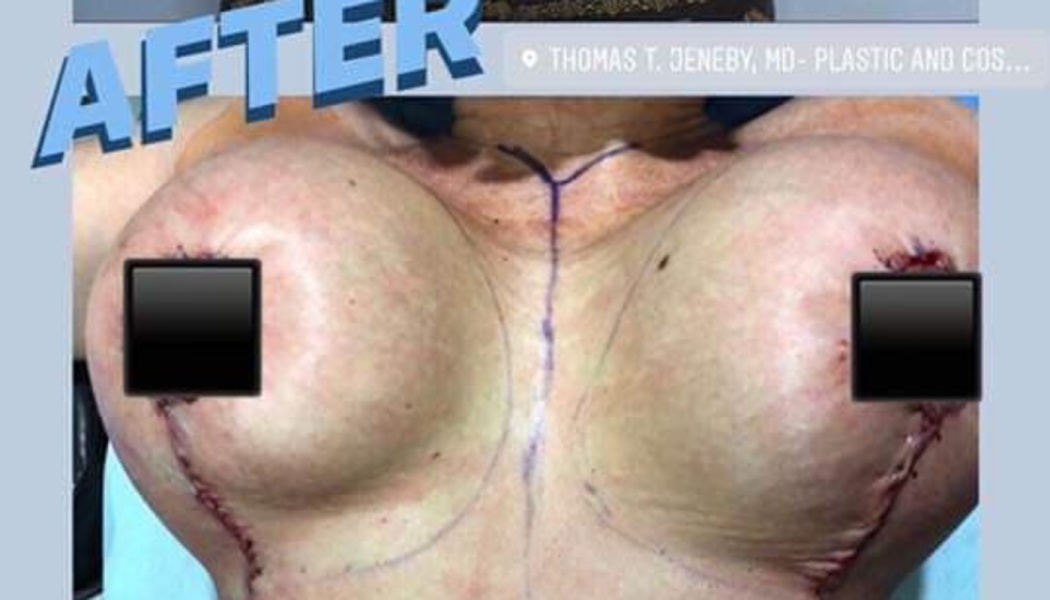 Post-operative breast surgery results featuring surgical markings, incisions, and a blue AFTER text overlay.