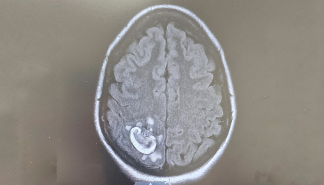 Brain MRI scan showing a distinct bright ring-like abnormality in the posterior brain tissue.