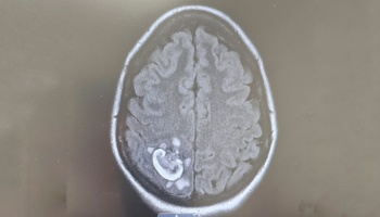 Brain MRI scan showing a distinct bright ring-like abnormality in the posterior brain tissue.
