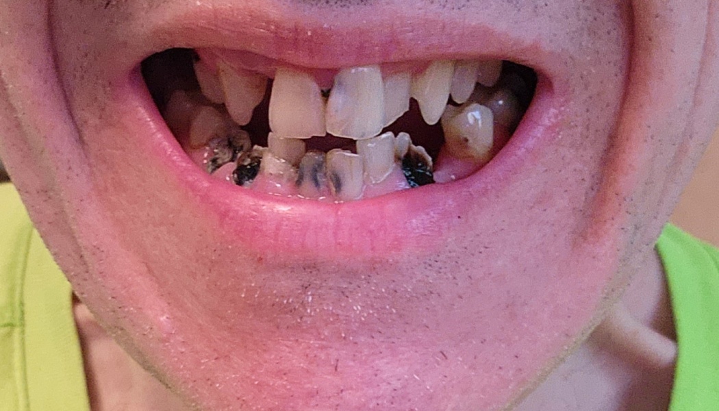 Close-up of a person's open mouth showing severely decayed, discolored, and misaligned teeth.