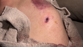 A small, deep puncture wound with surrounding redness and a large purple bruise on a person's skin.