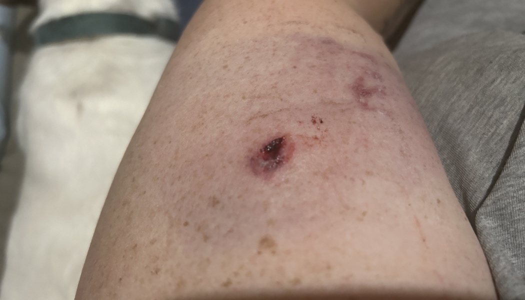 Small puncture wound and surrounding purple bruising on fair, freckled skin.