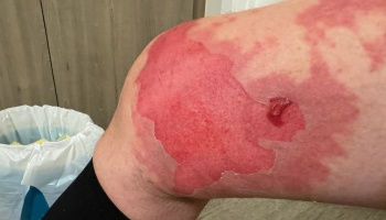 Severe red burn injury on a person's leg with raw, peeling skin.