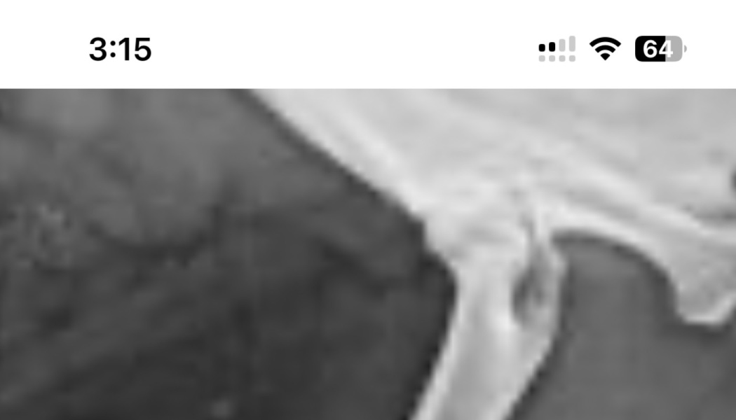 Close-up X-ray radiograph showing skeletal bones and a joint structure.