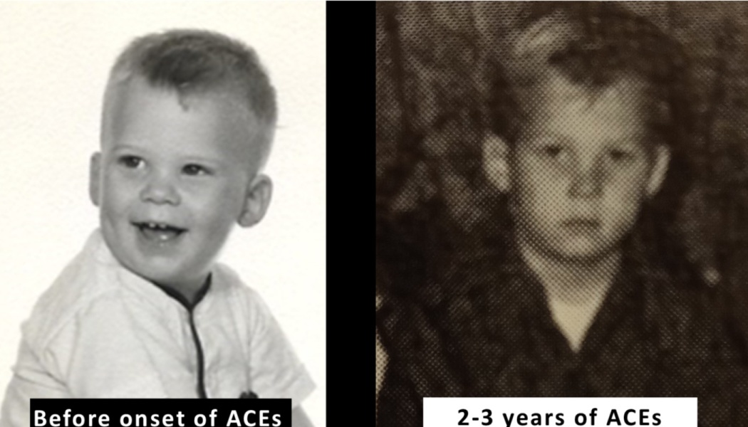 Side-by-side comparison showing a smiling young boy before ACEs and a somber boy after 2-3 years of ACEs.