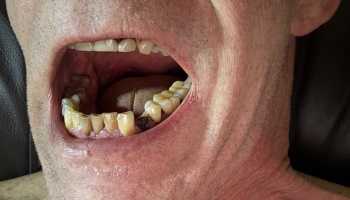 Close-up of an open mouth showing severely worn, discolored, and damaged teeth in need of dental care.
